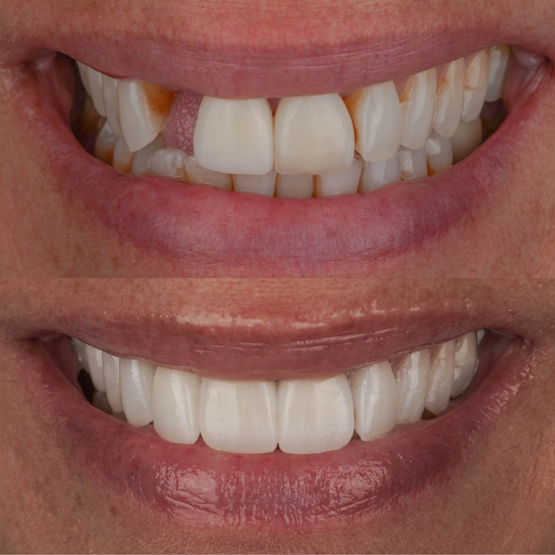Before and after dental implant with porcelain crowns